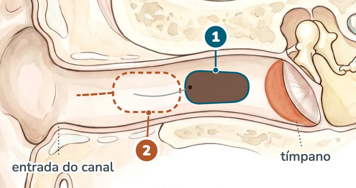 Ilustração da orelha em corte mostrando o canal do ouvido. O aparelho invisível no canal (1) é uma cápsula marrom no fundo do canal, perto do tímpano, com um fio fino para tirar. O microcanal (2), em contorno tracejado, fica mais perto da entrada do canal.