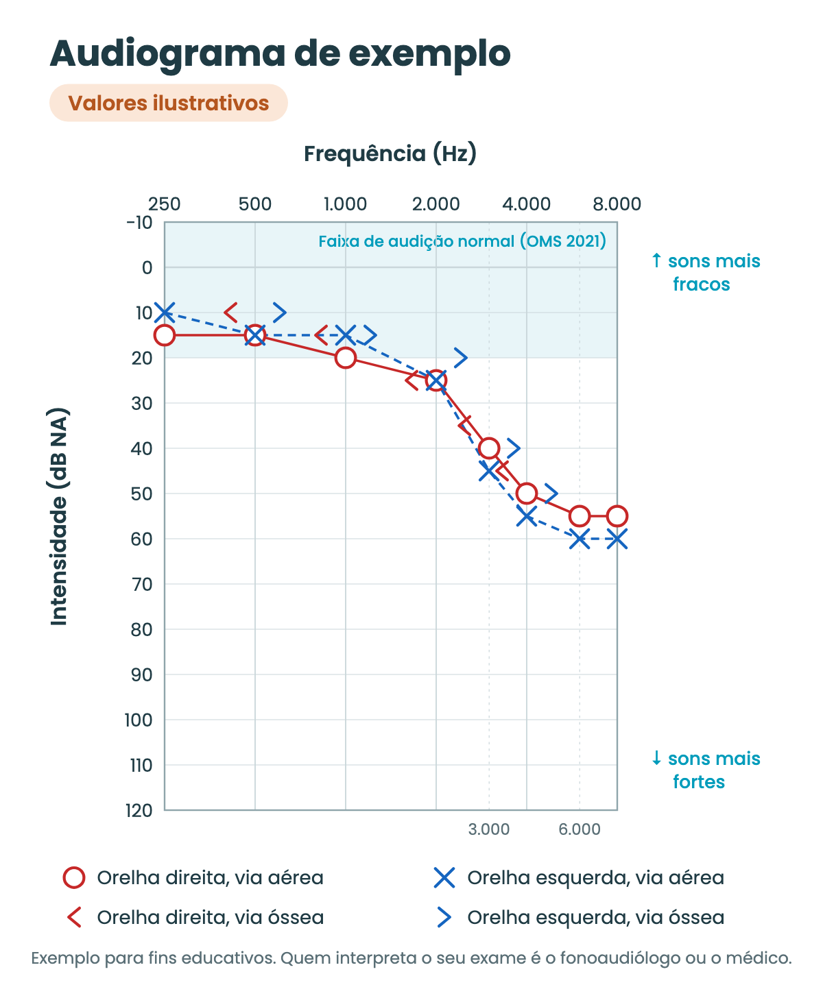 Audiograma de exemplo com valores ilustrativos. As frequências vão de 250 a 8.000 Hz no eixo de cima e a intensidade de -10 a 120 dB no eixo lateral, com os sons mais fracos no alto. Os círculos vermelhos da orelha direita e os xis azuis da orelha esquerda ficam entre 10 e 25 dB até 2.000 Hz e descem até 55 e 60 dB nos agudos. Os símbolos da via óssea acompanham a via aérea de perto.