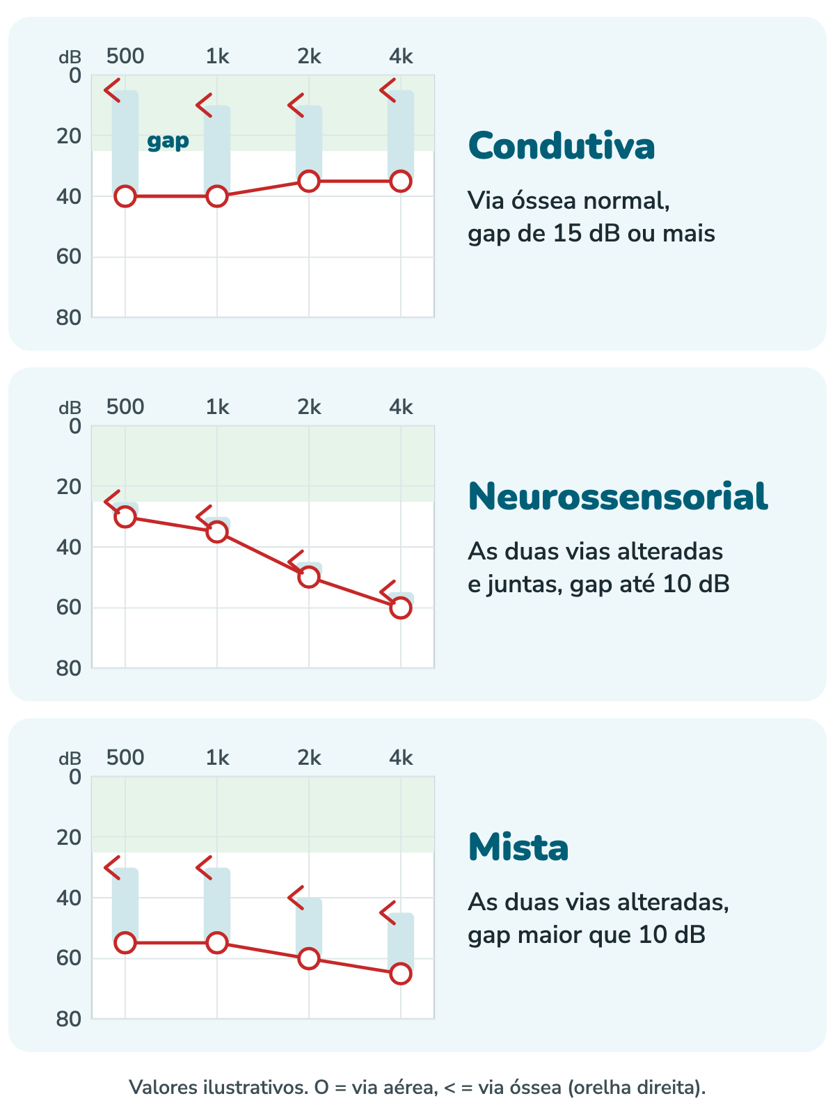 Três audiogramas da orelha direita com valores ilustrativos, de 500 a 4.000 Hz. Na perda condutiva, os símbolos da via óssea ficam entre 5 e 10 dB e os da via aérea entre 35 e 40 dB, com um espaço grande entre eles. Na neurossensorial, as duas vias descem juntas de 25 a 60 dB, com 5 dB de diferença. Na mista, a via óssea fica entre 30 e 45 dB e a via aérea entre 55 e 65 dB, com 20 a 25 dB de diferença.