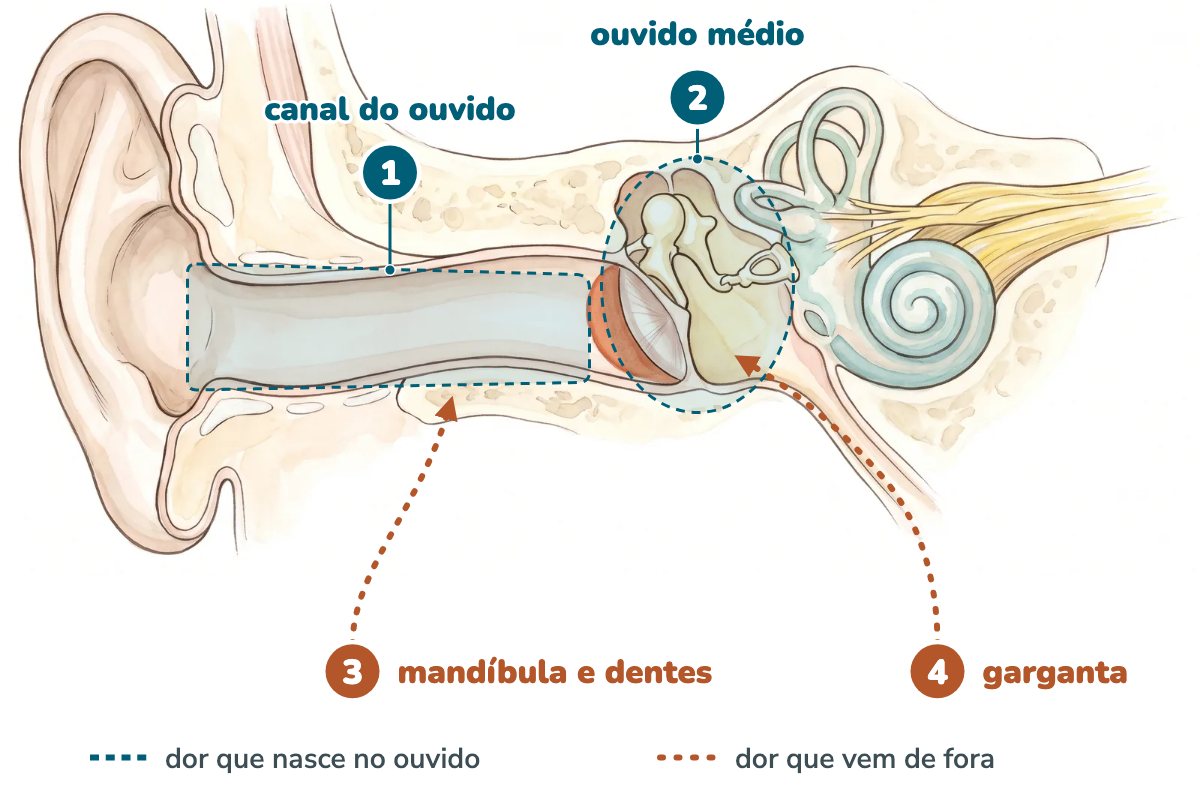 Ilustração da orelha em corte com quatro pontos numerados: o canal do ouvido e o ouvido médio destacados em azul como lugares onde a dor nasce no próprio ouvido, e setas tracejadas em terracota subindo da mandíbula e dos dentes e da garganta até o ouvido, mostrando a dor que vem de fora