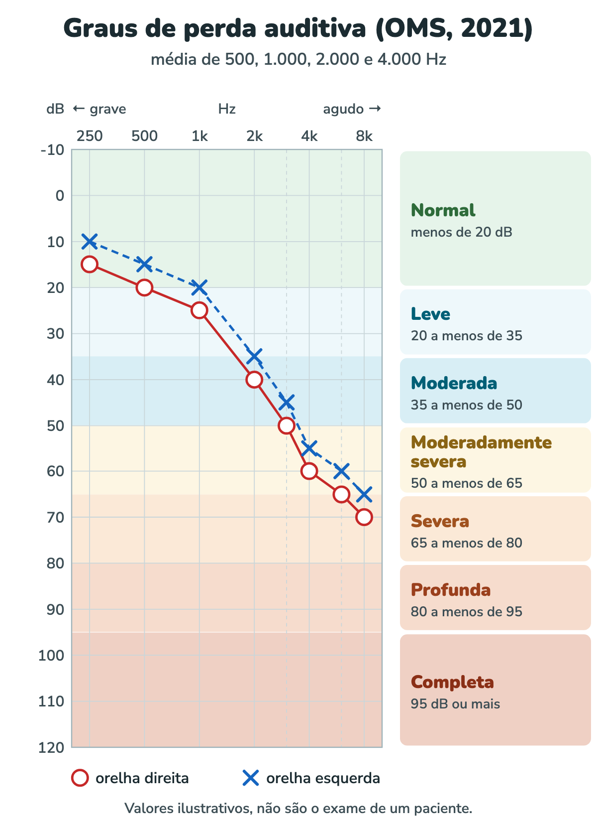 Audiograma com as faixas coloridas dos graus de perda auditiva da OMS: normal abaixo de 20 dB, leve de 20 a menos de 35, moderada de 35 a menos de 50, moderadamente severa de 50 a menos de 65, severa de 65 a menos de 80, profunda de 80 a menos de 95 e completa de 95 dB ou mais. Uma curva de círculos vermelhos da orelha direita e outra de xis azuis da orelha esquerda começam na faixa normal nos graves e descem até a faixa severa nos agudos.