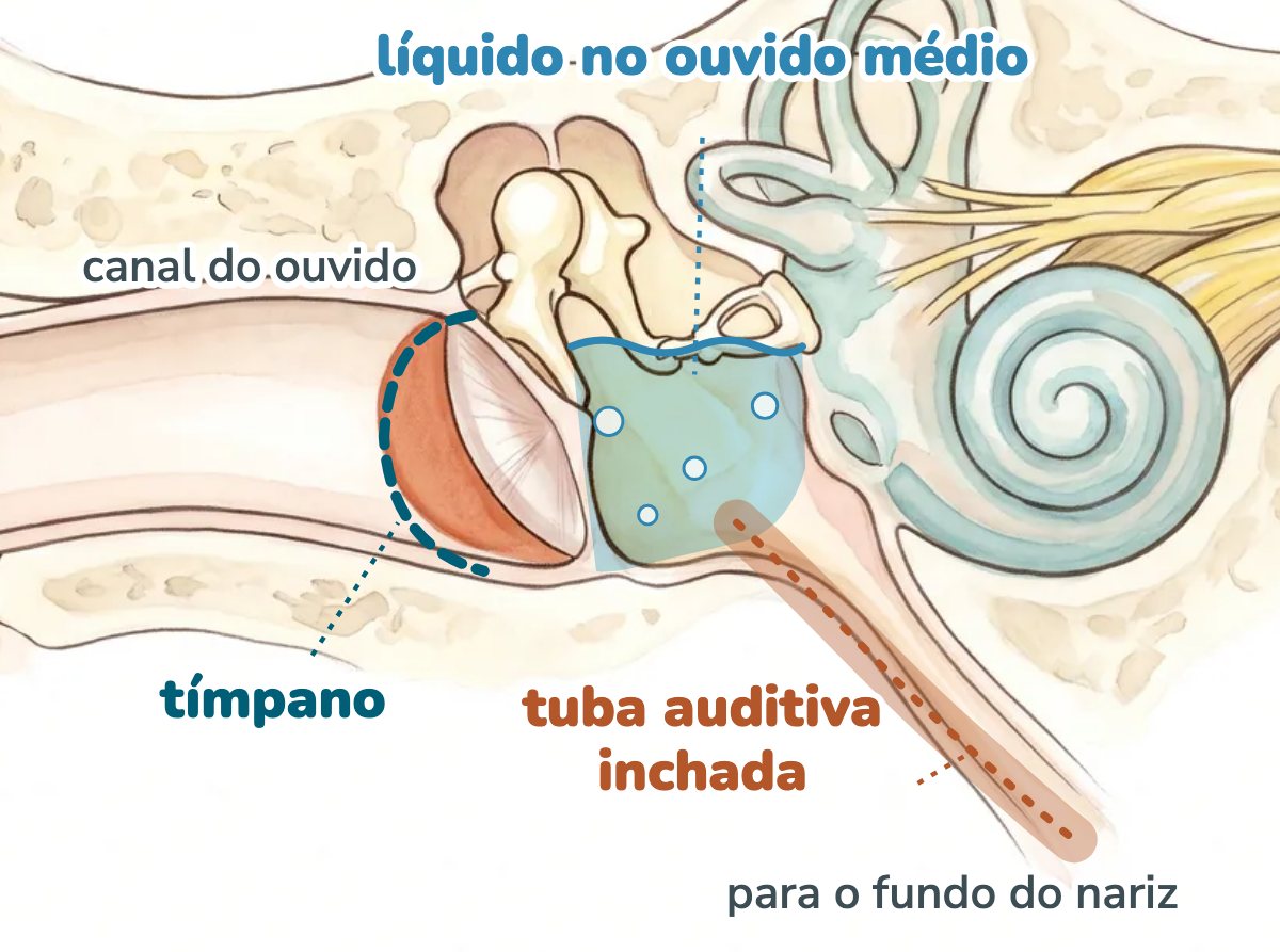 Ilustração da orelha em corte: atrás do tímpano, a parte de baixo do ouvido médio aparece cheia de líquido azul claro, abaixo dos ossinhos, e a tuba auditiva, destacada, desce do ouvido médio em direção ao fundo do nariz