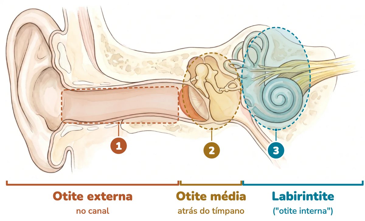 Ilustração da orelha em corte com três regiões destacadas: o canal do ouvido, onde acontece a otite externa; a orelha média, atrás do tímpano, onde acontece a otite média; e a orelha interna, com a cóclea e o labirinto, onde acontece a labirintite, chamada popularmente de otite interna