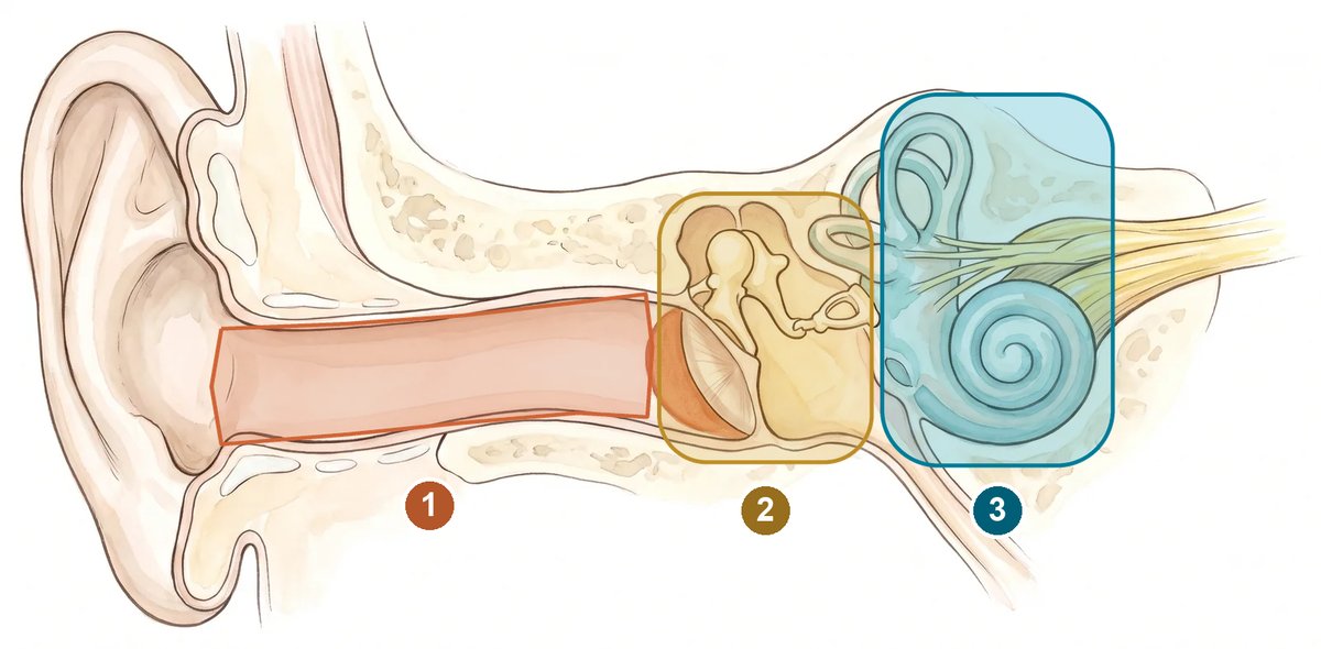 Ilustração da orelha em corte com três áreas coloridas: o canal do ouvido até o tímpano, o ouvido médio com os ossinhos e o ouvido interno com a cóclea em espiral