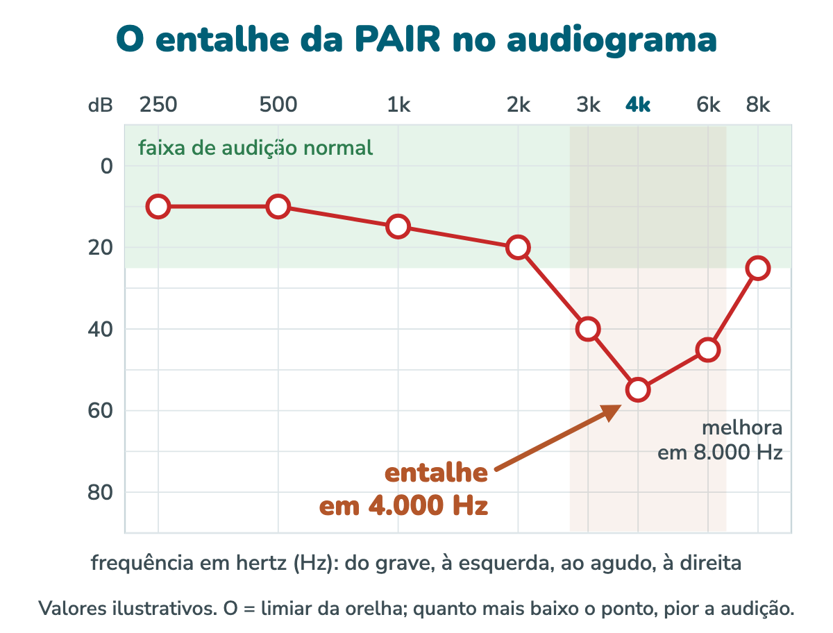 Audiograma ilustrativo de perda auditiva induzida por ruído: a linha fica na faixa normal de 250 a 2.000 Hz, cai até 55 dB em 4.000 Hz e volta a subir em 8.000 Hz, formando um entalhe em V