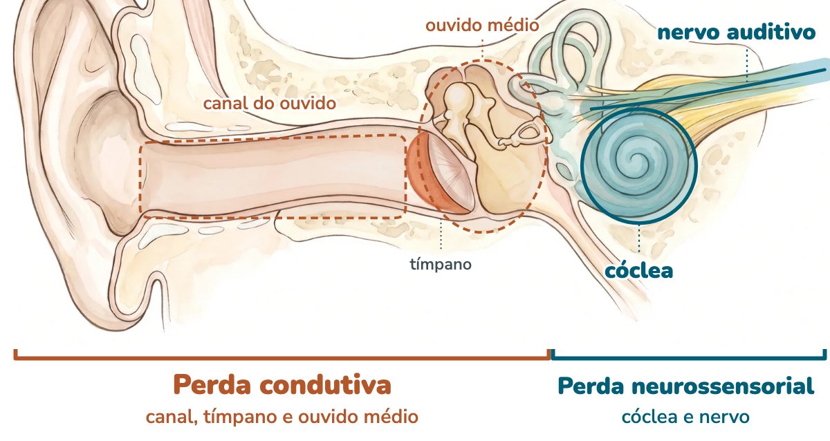 Ilustração da orelha em corte: o canal do ouvido e o ouvido médio aparecem contornados em terracota como a região da perda condutiva, e a cóclea e o nervo auditivo, destacados em azul, como a região da perda neurossensorial