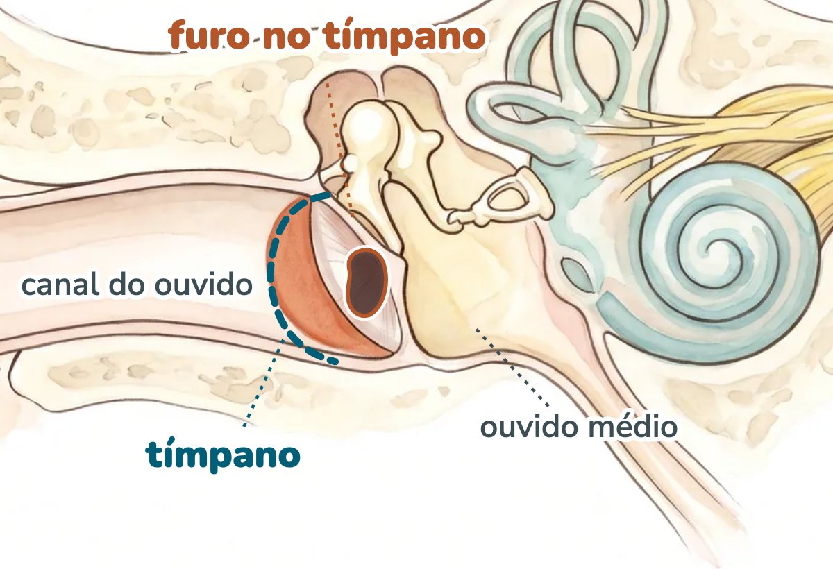 Ilustração da orelha em corte: no fundo do canal do ouvido, o tímpano aparece com um furo escuro no meio, destacado por um círculo tracejado, e logo atrás dele fica o ouvido médio com os ossinhos